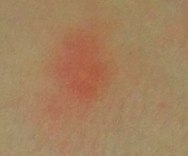 erythema toxicum detail